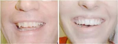 Sonrisa asimétrica por debilidad de los elevadores laterales del labio superior y del ángulo de la boca (cigomático mayor, elevador del ángulo de la boca, risorio): la comisura del lado débil queda descendida y la línea labial se inclina. Es el patrón que reproduce una inyección demasiado inferolateral en patas de gallo. Benedetto 2006, figura 4.36.